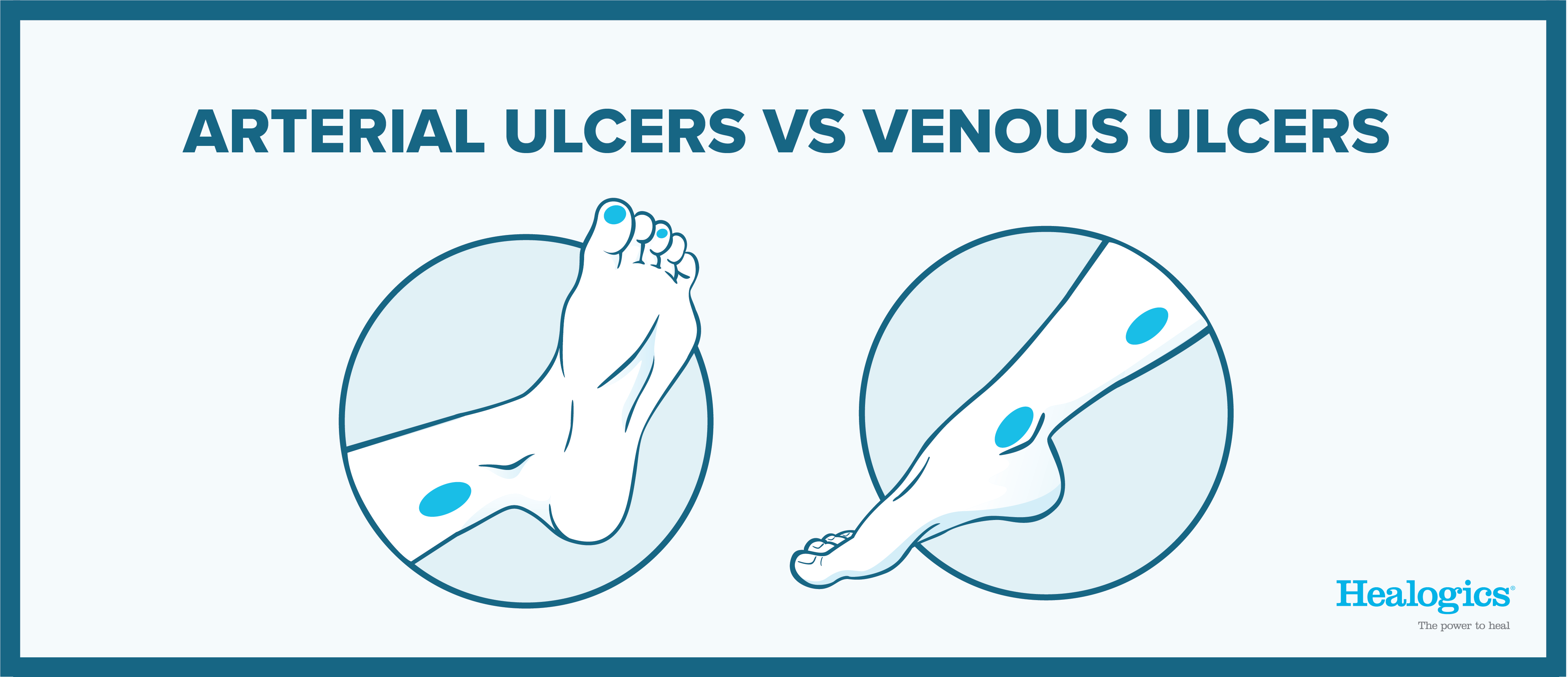 Arterial vs. Venous Ulcers: What Are the Differences?